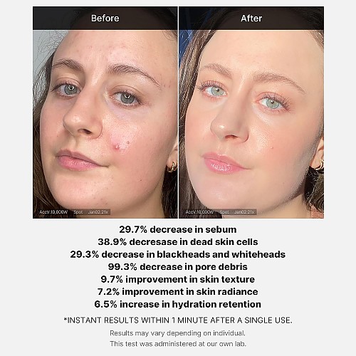 [MEDICUBE] Red Acne Succinic Acid Peel 40g